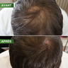 BBHair Densité Pro Dermaroller BBHair Densité Pro Dermaroller